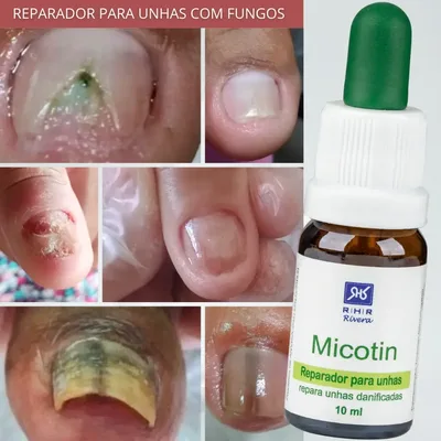 Remédio Para Micose De Unha - Micose Severa Micotin 10ml Água